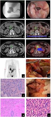 Peritoneal Metastasis After Treated With Abemaciclib Plus Fulvestrant for Metastatic Invasive Lobular Breast Cancer: A Case Report and Review of the Literature